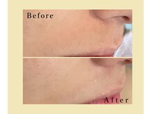 リノ(Lino)/お顔脱毛