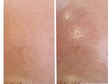 リュミエール(umiere)/毛穴、ハリ、ツヤ