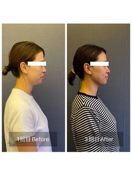 サロン グリッター 新宿(Salon GLITTER)/【小顔】ビフォーアフター