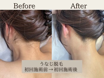 インベスト(INVEST)/うなじ脱毛