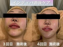 ラディアント(Radiant)/インディバ術後ケア/肌質改善