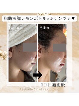 ビヌ(Binu)/脂肪分解レモンボトル・小顔ケア