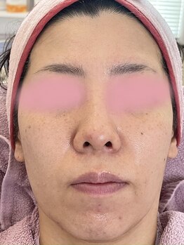 リフティングラボ(LIFTING LAB)/バイオセルショット65導入