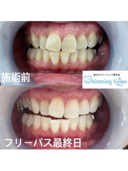 ホワイトニングサロン 熊本店/セルフホワイトニンングケア