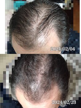 ルーチェ(LUCE)/頭皮美容液 使用