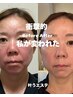【ツヤ肌小顔肌質改善♪最強コンビ！】ラミネーションピール&高密度超音波UDM