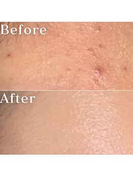 ミニョスキンラボ/ニキビ卒業パッケージ4回