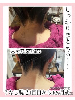 サロンシャイン(Salon Shine)/うなじ脱毛経過