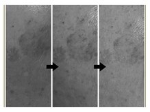 エヌエクラ(N.eclat.)/シミ