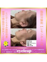 アイリープ(eyeleap)/☆レモンボトルビフォーアフター