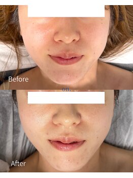 オン(on.)/《お客様症例》施術1回