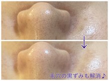 テールボーテ(Terre beaute)/毛穴の黒ずみ解消☆