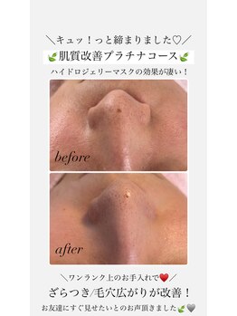 リーミー(Re:me)/★肌質改善プラチナコース★