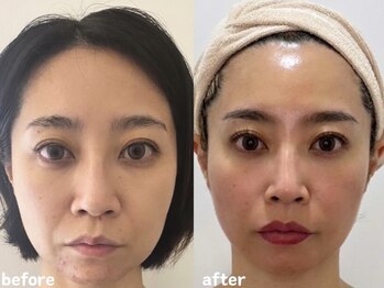 エムプリュ 心斎橋店(M.plus)/小顔バスト施術13回