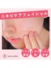 【喜びの声続出】ニキビの改善！ニキビケアフェイシャル   8800円
