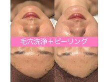 レアマカナ(LeaMakana)/毛穴洗浄＋ピーリング