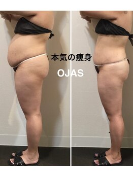 オージャス(OJAS)の写真/太もも・ヒップ集中ケア！本気で痩せたい結果重視派へ♪弛まずスッキリ健康的な理想のボディへ◎