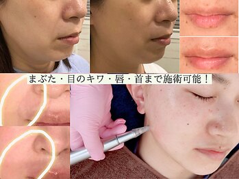 サロンドエルサ(Salon de ELSA)の写真/【人気NO.1エイジングケア】年齢サインを根本からケア。メタジェクトで若々しいハリ艶肌へ導く施術