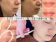 サロンドエルサ(Salon de ELSA)の写真/【人気NO.1エイジングケア】年齢サインを根本からケア。メタジェクトで若々しいハリ艶肌へ導く施術