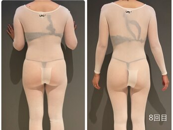 アルバ 広島店(ALBA)/エンダモロジー〈痩身ボディ〉