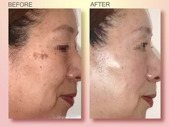 ジュリア オージェ 京橋店/ ビフォーアフター(シミケアP)