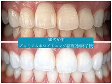 歯のホワイトニング 岐阜アクティブG店/プレミアムホワイトニング施術☆