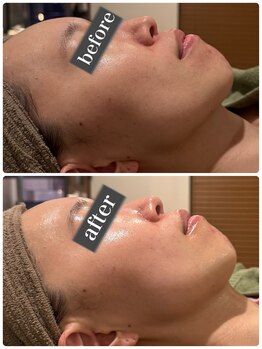 セルベッラ(cerbella)/小顔艶肌ボンバーフェイシャル