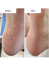 ケアプラス(care plus)/足裏角質ケア