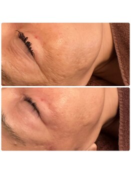 ジョルジオ東京/プラズマフラクショナル