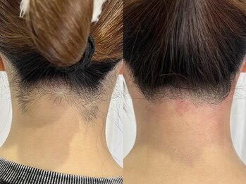 シロ(Shiro)/MIX脱毛うなじデザイン