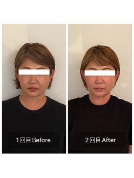 サロン グリッター 新宿(Salon GLITTER)/【小顔】ビフォーアフター