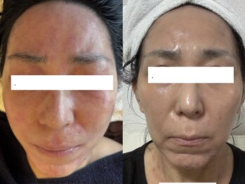 ジョーヌ(JAUNE)/お肌の赤みを徹底鎮静！