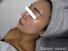 ナチュールムーン(Nature moon.)/ハーブピーリング after