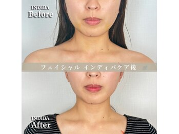 術後の女神 大阪本町店/ダウンタイムケア・インディバ