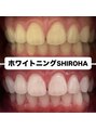 シロハ(SHIROHA) セルフホワイトニング/大阪/天王寺/小顔/ホワイトニング/美白