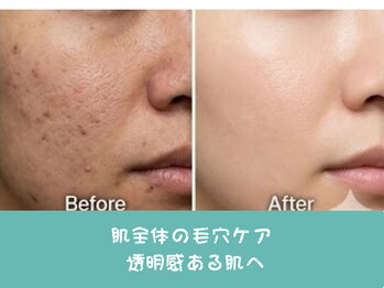 ココミエレ(COCO MIELE)の写真/【黒ずみ毛穴もつるん♪】蒸気×専用美容液で角栓を浮かしだす！プロ厳選の本格毛穴洗浄◎メンズ歓迎