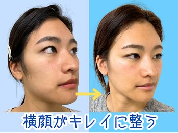 ナチュラルビューティーフェイス 横浜(NBF)/エラ・頬骨もスッキリ/横浜小顔