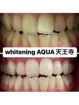 アクア 天王寺店(AQUA)/セルフホワイトニング効果