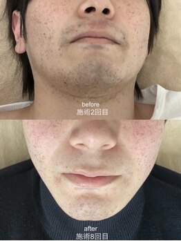 モット いこらもーる泉佐野店(mot)/ヒゲ脱毛