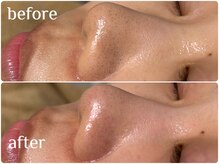 ワイスリー(Y3)/水素毛穴洗浄コース