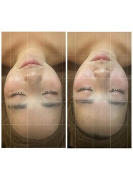 キリグ(KILIG)/【小顔矯正】一回でこの効果!