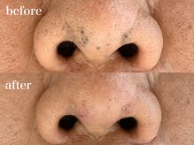 ビエント(VIENTO)/長年放置の諦めてた黒ずみが！！