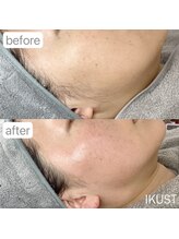 イクスト 吉祥寺(IKUST)/【フェイシャルワックス/脱毛】