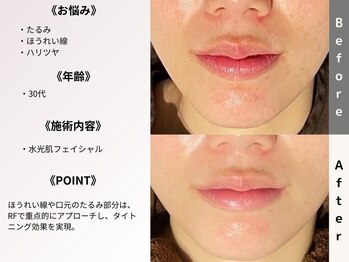 ルディラ 大宮店/水光肌フェイシャル