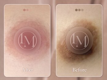 クローバー 松戸(clover)/【ルメラ】乳輪　黒ずみケア