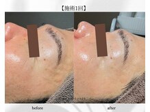 アン ビューティー(ann beauty)/施術1回【症例写真】30代