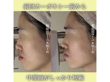 ハニエル(Haniel)/カーボキシー症例