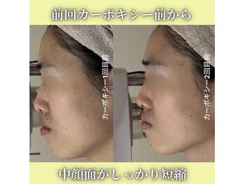 ハニエル(Haniel)/カーボキシー症例