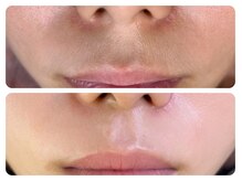 ドクターリバース(Dr.Reverse)/美肌効果のあるLED顔脱毛