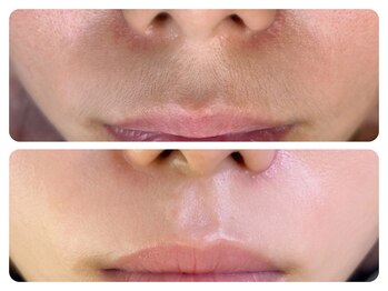 ドクターリバース(Dr.Reverse)/美肌効果のあるLED顔脱毛